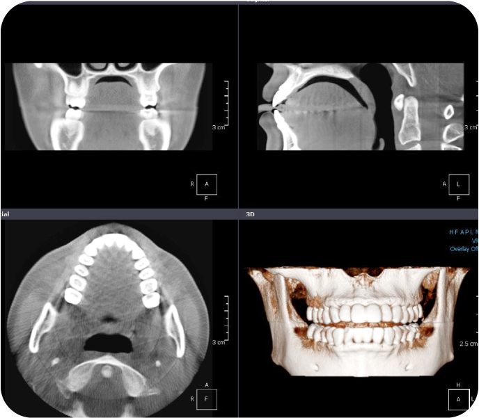 CTによる精密な口腔診断